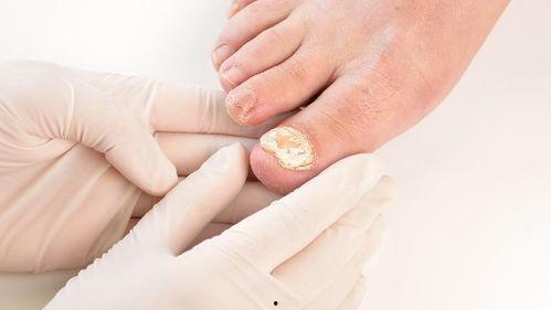 明星灰指甲,揭秘明星健康困扰背后的真相